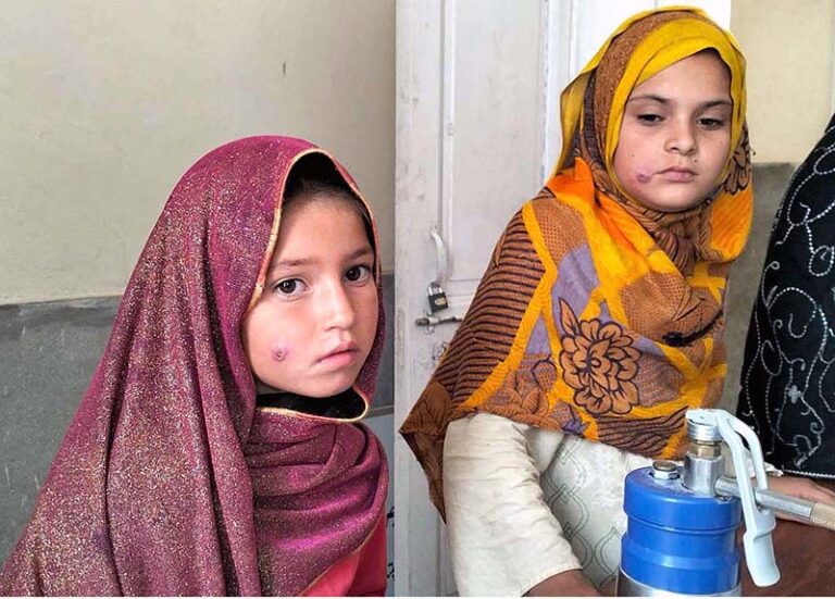 A skin disfiguring infection surging in KP